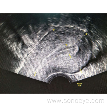 color doppler transvaginal probe